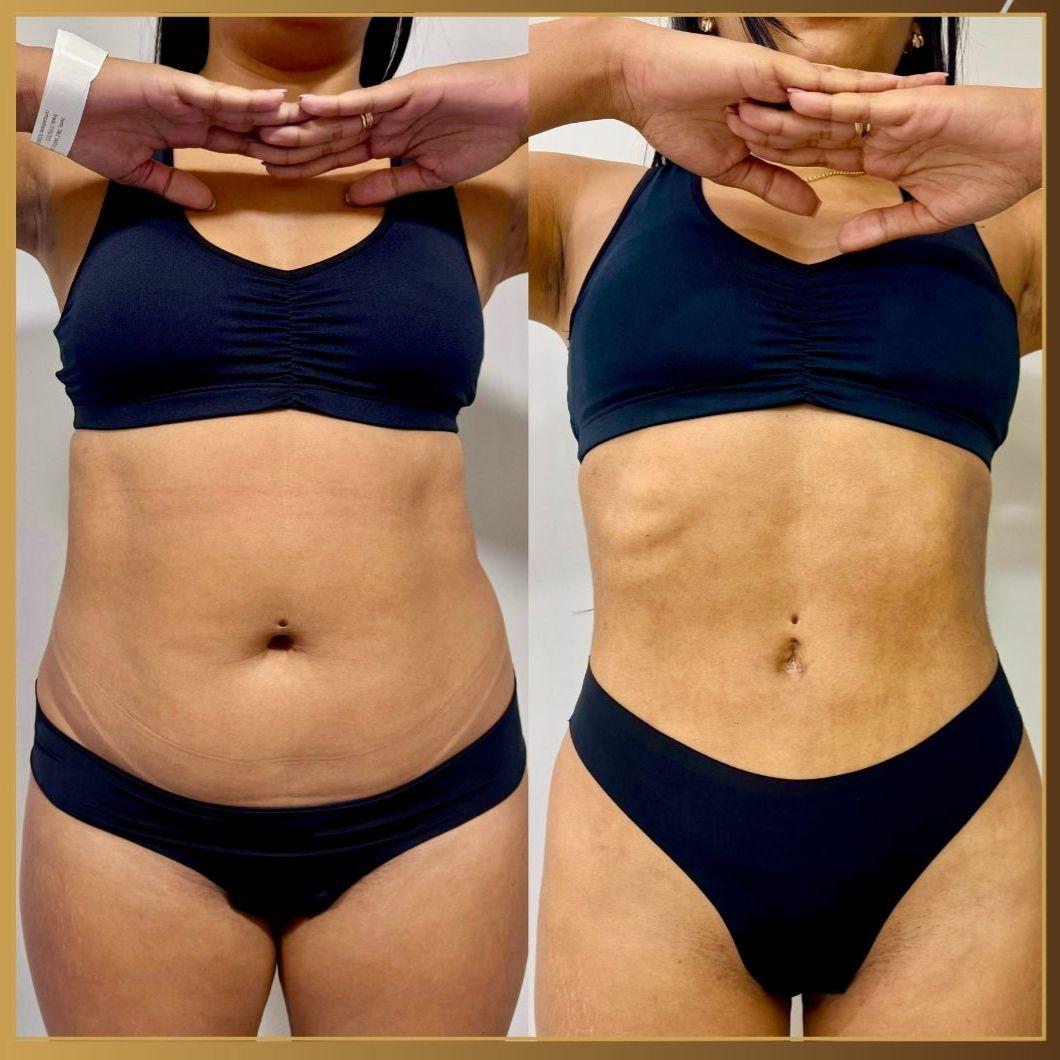 Antes e depois — Mini Lipo