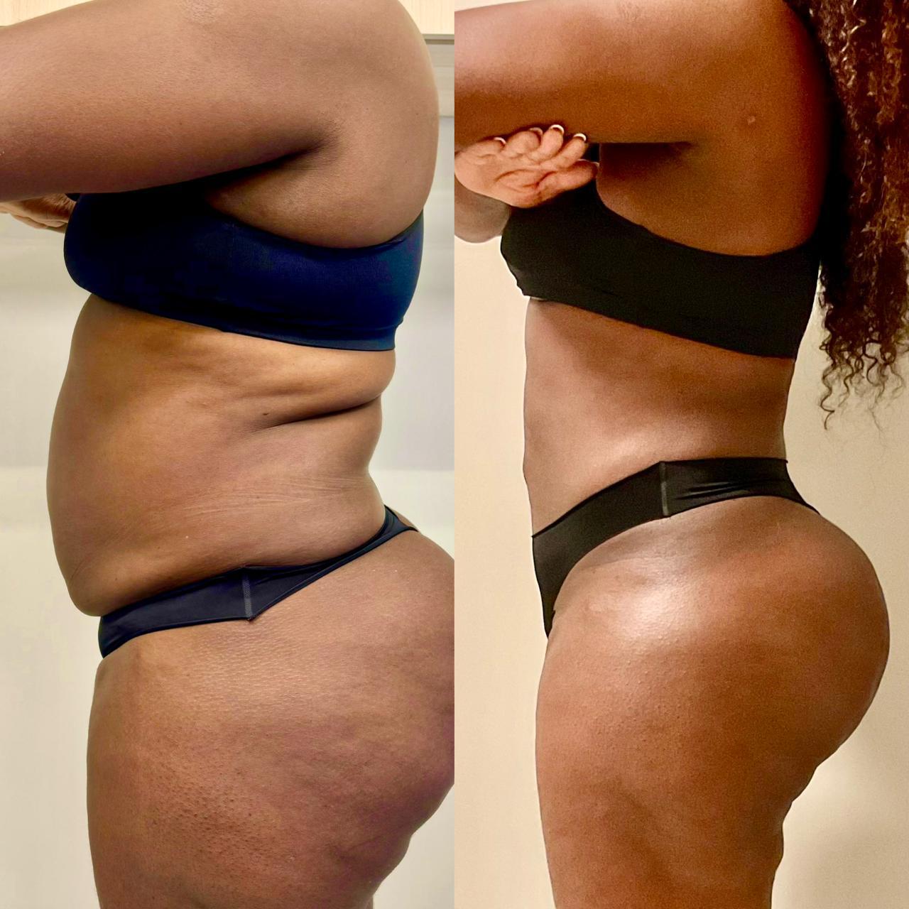 Antes e depois — Remodelamento Glúteo