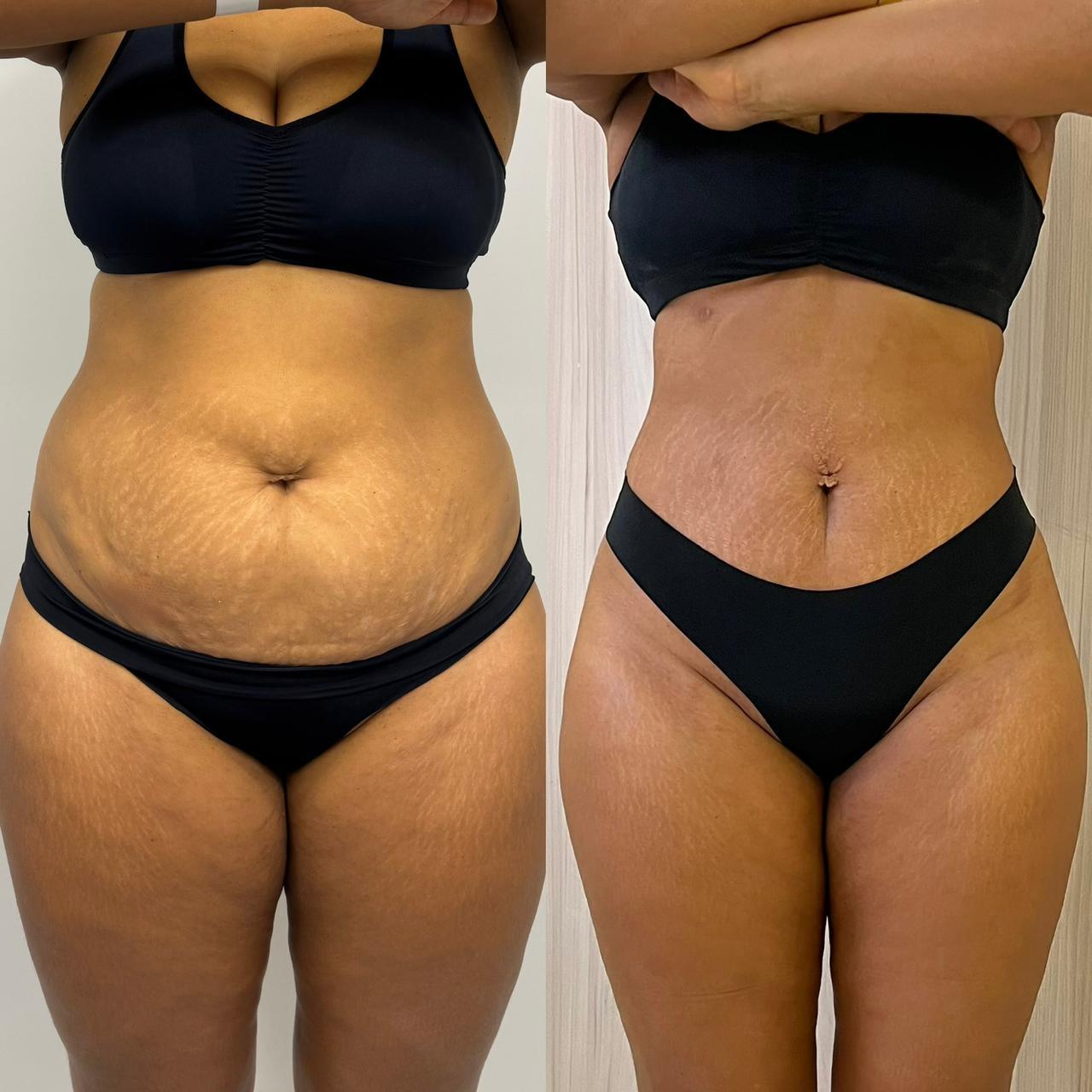 Antes e depois — Mini Lipo abdômen